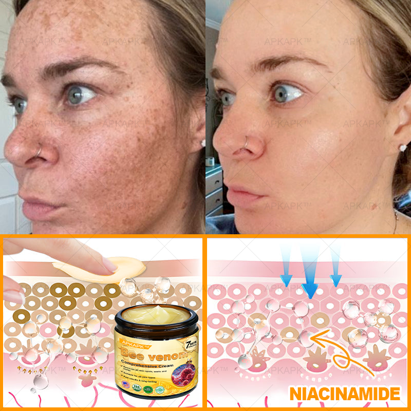 👨‍⚕️𝐌𝐇𝐑𝐀 Official Store Made and Shipped from USA ✨  APKAPK® Bee venom Comprehensive Cream with Collagen & Matrixyl 3000|Obesity🔥 Sagging Skin, Fine Lines, Loss of Firmness, Flat Bust, Drooping Hips, and More
