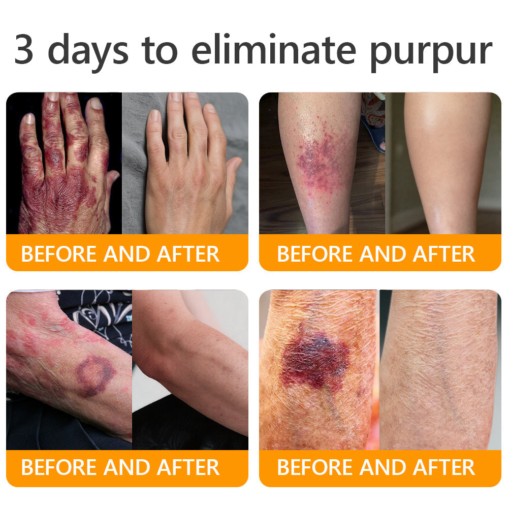 👨‍⚕️𝐌𝐇𝐑𝐀 Official Store Made and Shipped from USA ✨  APKAPK® Bee venom Comprehensive Cream with Collagen & Matrixyl 3000|Obesity🔥 Sagging Skin, Fine Lines, Loss of Firmness, Flat Bust, Drooping Hips, and More