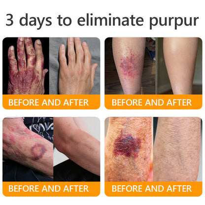 👨‍⚕️𝐌𝐇𝐑𝐀 Official Store Made and Shipped from USA ✨  APKAPK® Bee venom Comprehensive Cream with Collagen & Matrixyl 3000|Obesity🔥 Sagging Skin, Fine Lines, Loss of Firmness, Flat Bust, Drooping Hips, and More